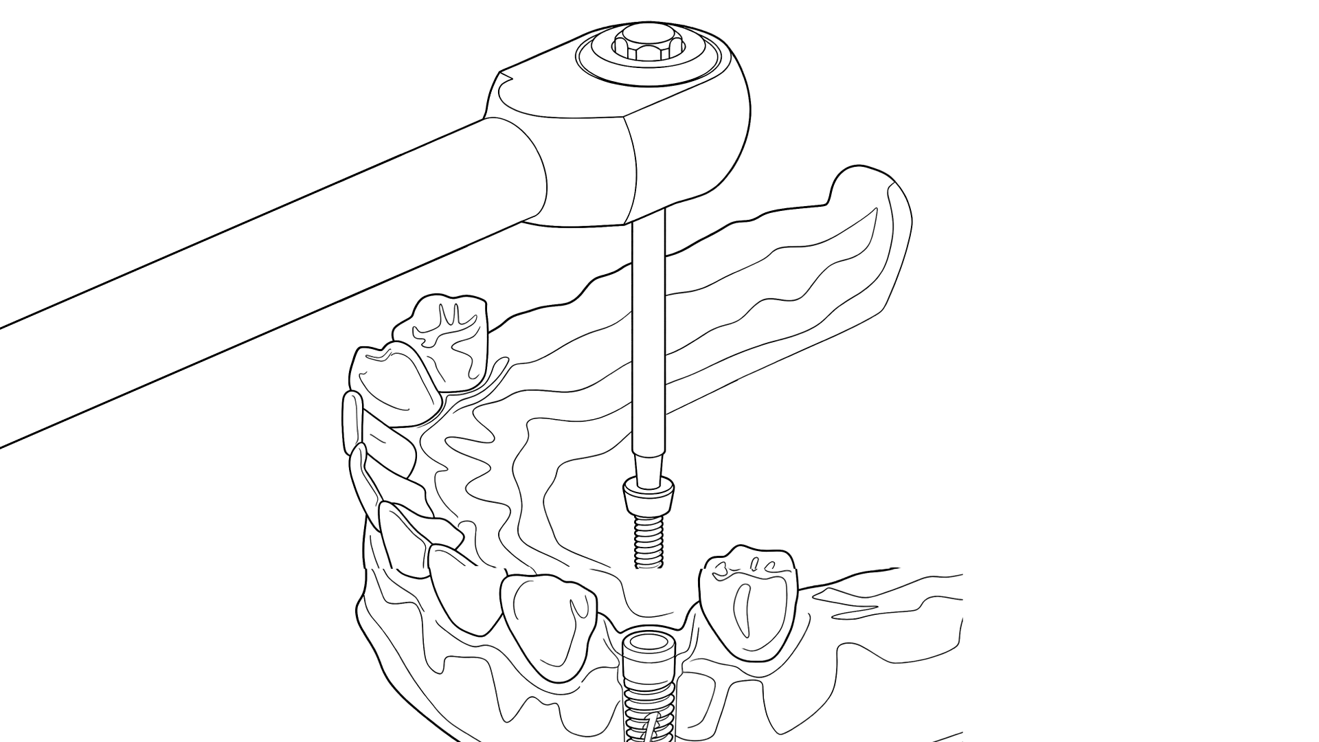 Zubní implantáty Zubní implantáty